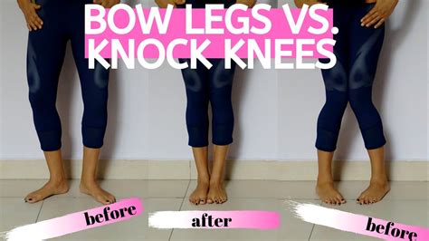Bow Legs Yoga Which Muscles Should You Strengthen To Fix Bow Legs