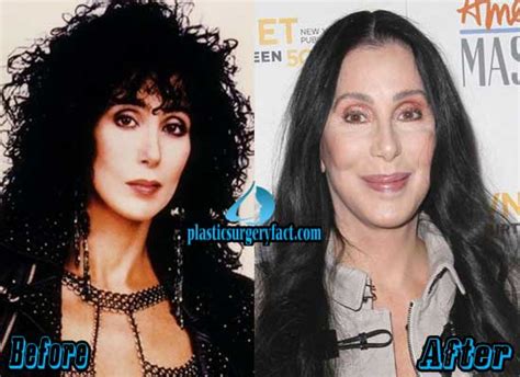 Cher Plastic Surgery Before And After Photos