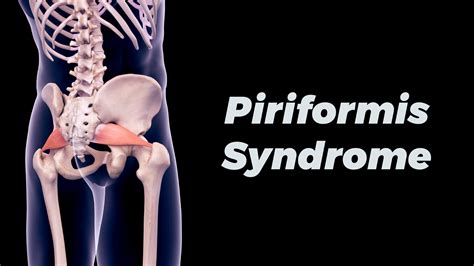 Piriformis Syndrome Treatment Radius Physical Sports Rehab
