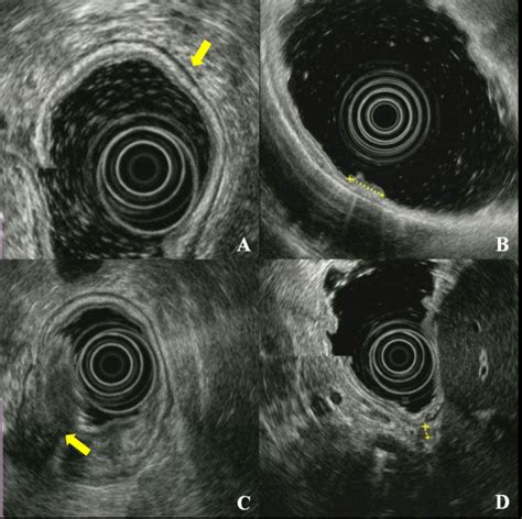 Endoscopic Ultrasonography Eus A Eus Showing Normal Layers Of