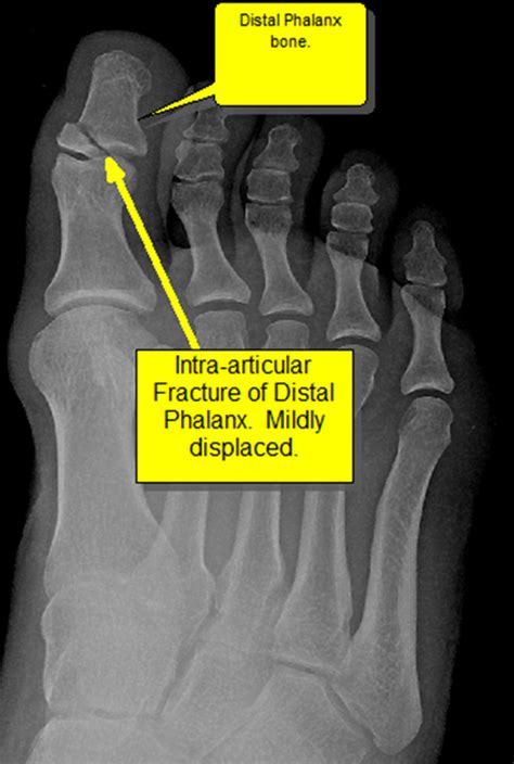 Foot Trauma Fracture Of The Interphalangeal Joint Of The Great Toe