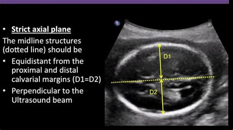 Tmt Fetal Imaging Imaging The Lateral Ventricles Alpana Joshi