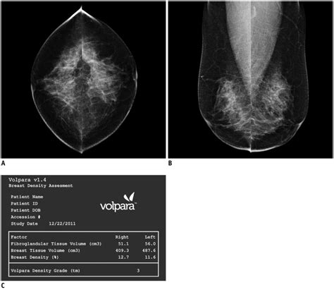 Mammogram Performed In 55 Year Old Woman During Routine Check Up A B