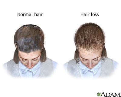 Top Reason For Hair Loss In Female
