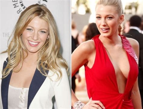 Celebrity Before And After Plastic Surgery Blake Lively Before And After Breast Implants