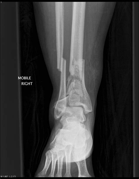 Tibial Plafond Fracture Anatomy