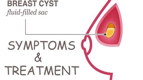 What Are Breast Cysts Breast Cyst Symptoms And Treatment Of Breast Cyst