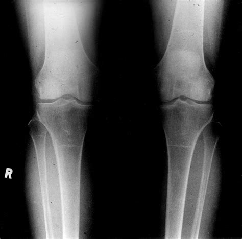 Debilitating Knee Pain In A Patient With “normal” Radiographs Annals