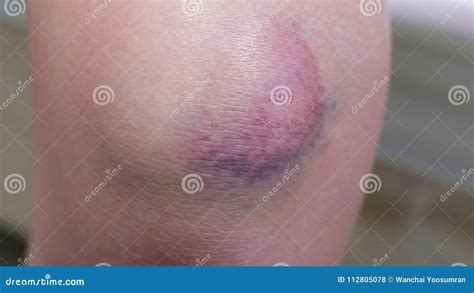 Bruise Injury On Knee Stock Photo Image Of Young Injured 112805078