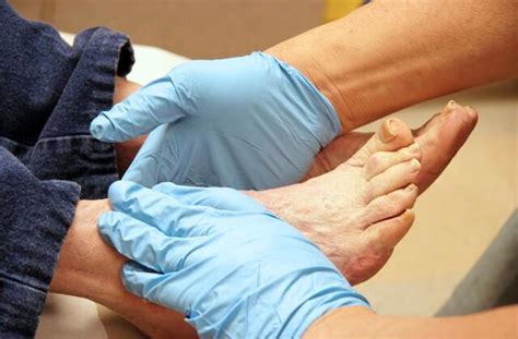 The 411 On Diabetic Foot Ulcers For Better Us News