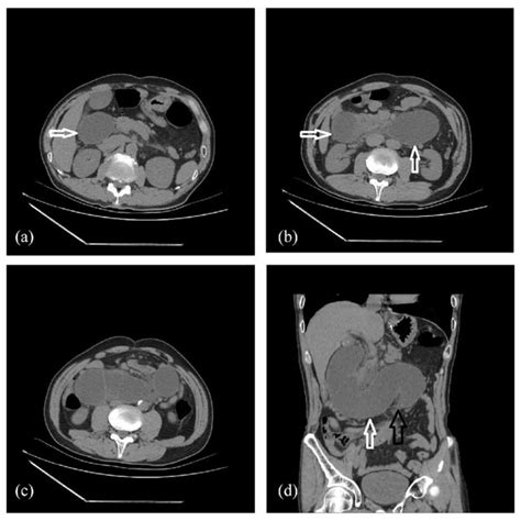 Abdominal CT Scans Illustrated Favorable Postoperative Imaging