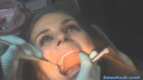 Girl At The Dentist Getting Amalgam Fillings And Bridge Full Video Of