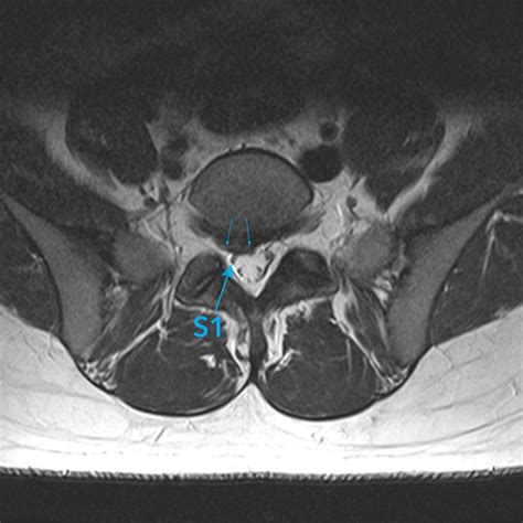 Mri Assessment Of Child With Right Sided Sciatica Axial Image Mri At