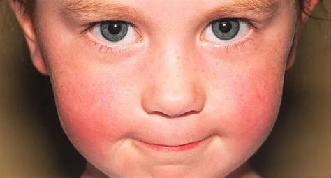 Covid 19 Skin Rash Pictures Child Henoch SchÃ¶nlein Purpura Hsp