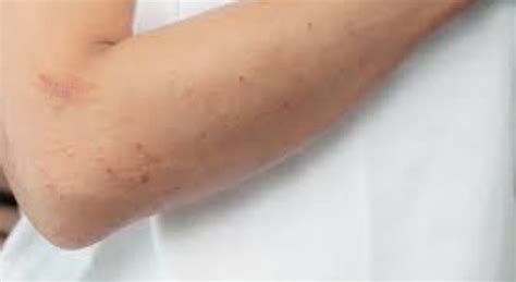 Skin Lesions Types Diagnosis Treatments Leannbulk