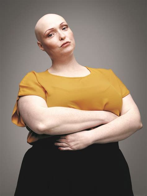 i was bullied for my alopecia but now i embrace not having any hair bald head women bald girl