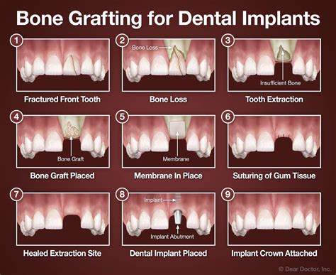 Bone Grafting For Dental Implants Dental Innovations Mark D
