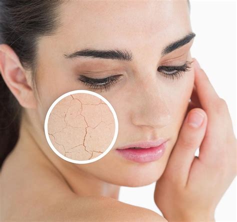 A Refresher On Treating Dry Skin Sutton Dermatology Aesthetics Ctr