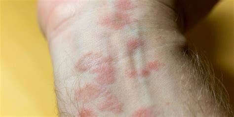 Pictures Of Skin Rashes In Adults