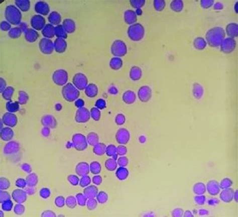 Cytology Of The Pleural Fluid Showing Sheets Of Plasma Cells With