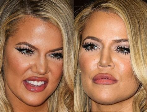 Now that khloe kardashian has opened up about the work she has had done, fans are hoping that the internet trolls bashing her looks will call it quits! Khloe Kardashian Wrong Plastic Surgery Before And After Fillers Photos