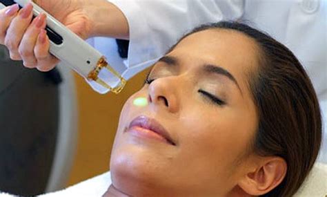 Eximer Laser Treatment For Vitiligo Skin Care Network