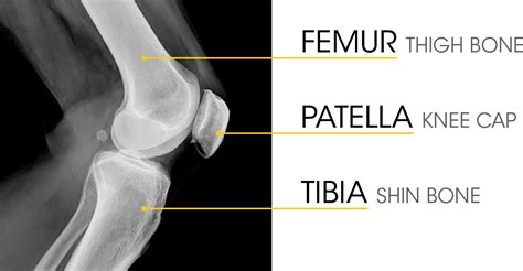 Understanding The Role Of Cartilage In The Knee