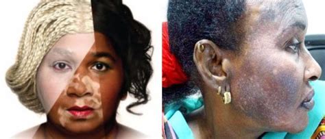 Pros And Cons Of Skin Lightening Toning And Bleaching
