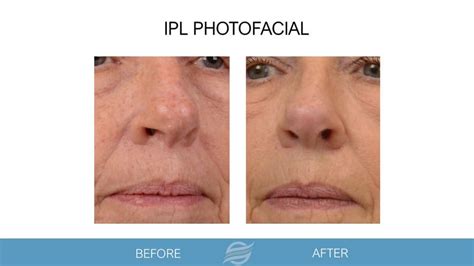 Ipl Photofacial Olam Med Spa