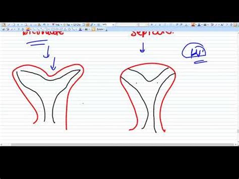 Difference Between Bicornuate And Septate Uterus YouTube