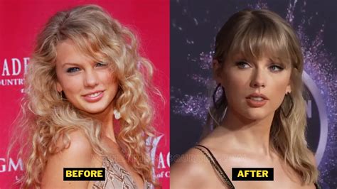 Taylor Swift Plastic Surgery Her Teeth Veneers And Before After