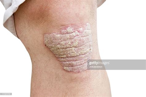 Psoriasis On A Mid Age Mans Knee High Res Stock Photo Getty Images