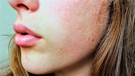 7 Common Rosacea Triggers According To A Skin Specialist Ghp News