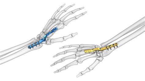 Wrist Fusion Surgery Everything You Need To Know Manchester Hand