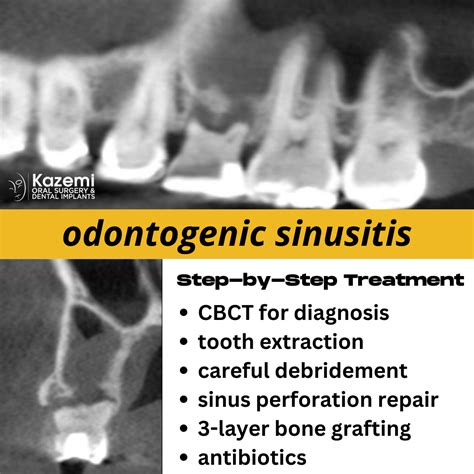 Sinusitis From Tooth Infection Sinusitis From Tooth Infection Kazemi Oral Surgery