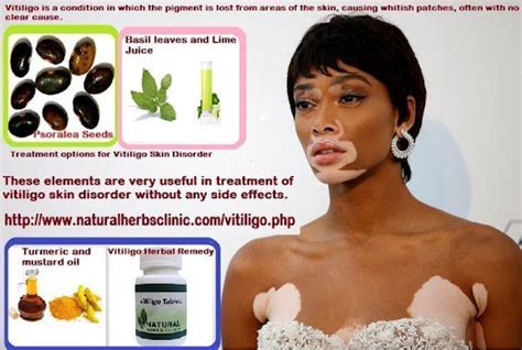 Other Natural Remedies Vitiligo Treatment For Skin Depigmentation