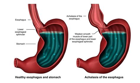 Cary Gastroenterology Associates What To Know About Esophageal