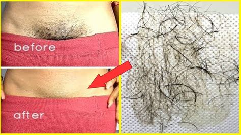 How To Remove Hair Permanently From Private Parts
