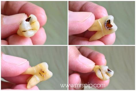 Kemungkinan yang dapat terjadi adalah kontak paksa gigi geraham dengan gigi lain. Mrs Pip || The Reviewer