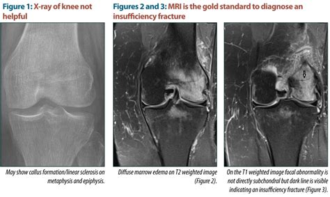 Insufficiency Fractures of the Femur and Sacrum ...
