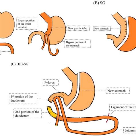 Different Types Of Bariatric Surgery A Mini Gastric Bypass