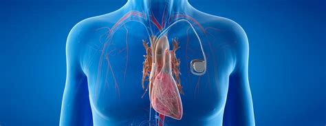 Pacemaker Conditions And Treatments Ucsf Health