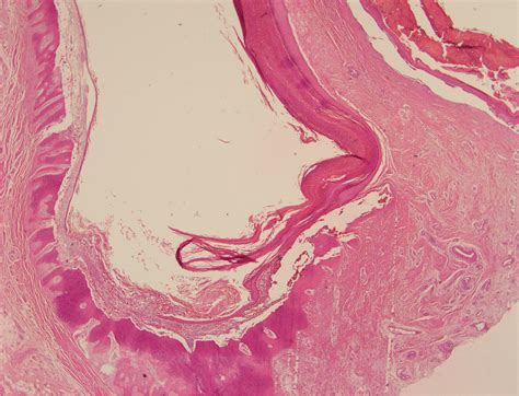 Epidermal Inclusion Cyst Histology