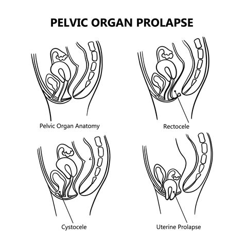 Pelvic Organ Prolapse Variously Monochrome Education Vector Set 20432177 Vector Art At Vecteezy