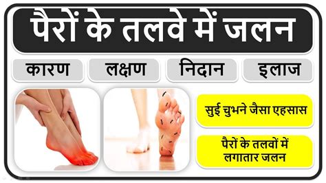 पैरों के तलवे में जलन तलवे में झुनझुनाहट कारण लक्षण इलाज दवाईयां Burning Feet Youtube