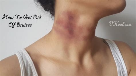 How To Get Rid Of Bruises Naturally 10 Tips