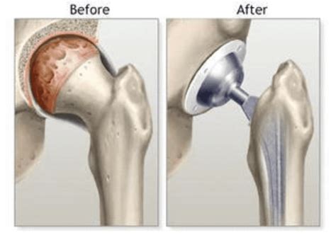 Video Watch An Anterior Hip Replacement Midwest Center For Joint