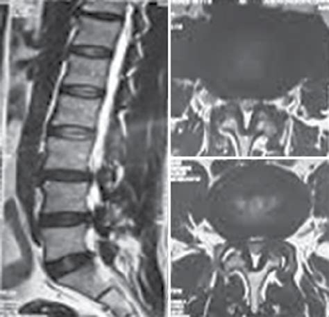 Magnetic Resonance Imaging Lumbar Shows Lateral Recess Stenosis At My