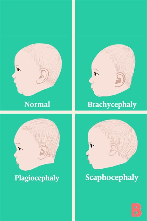 Plagiocephalyflat Head Syndrome Flat Head Syndrome Flat Head Baby