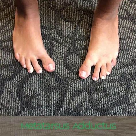 Pediatric In Toeing Pigeon Toes Causes And Treatment